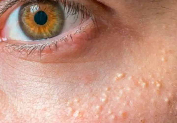 Cómo eliminar milium de la cara, las bolitas blancas alrededor de los ojos