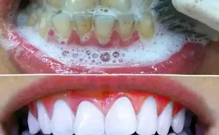 ¿Deseas blanquear tus dientes? Aquí te presentamos 4 remedios caseros para lograrlo!
