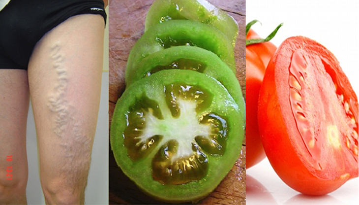 Cómo usar Tomates para Eliminar las Venas Varicosas