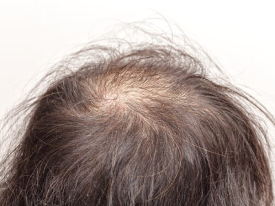 ¿Cómo detener la caída del cabello causada por la caspa?