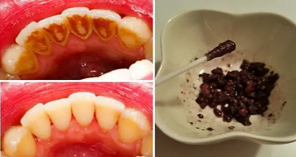 Cómo blanquear los dientes, prevenir el mal aliento, el sarro y la placa con solo 1 ingrediente