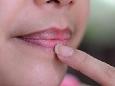 ¿Cómo deshacerse de los labios oscuros de forma rápida y natural?
