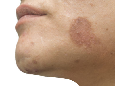 Exfoliantes caseros para eliminar las manchas oscuras del rostro