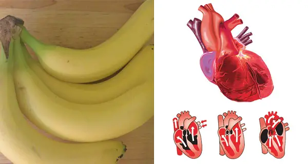 5 problemas de salud que puede curar con plátanos en lugar de medicamentos