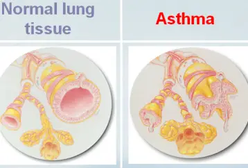 Recetas increíbles de té para tratar el asma de forma natural: tratamiento casero