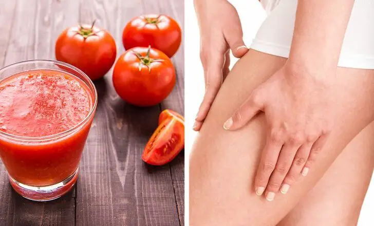 Remedio Casero con Tomate para Tratar las Venas Varicosas