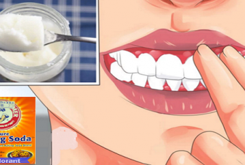 Cómo curar la gingivitis con cúrcuma, aceite de coco, bicarbonato de sodio o limones (no se requiere dentista)