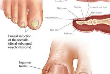 Cómo deshacerse de los hongos en las uñas de los pies con solo 3 remedios caseros simples