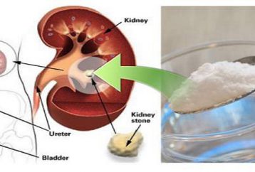 Cómo reparar su riñón dañado naturalmente usando 1 cucharadita de bicarbonato de sodio