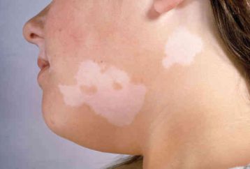 Dile adiós al vitiligo: 3 remedios caseros para tratar el vitiligo naturalmente