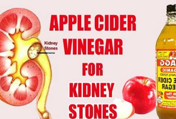 ¡Maneras muy fáciles de usar vinagre de sidra de manzana para cálculos renales!
