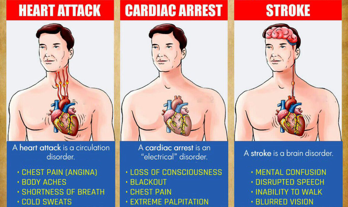 Debe conocer las diferencias entre un ataque cardíaco, un paro cardíaco y un accidente cerebrovascular