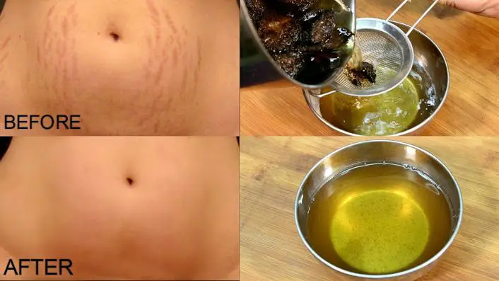 Learn how to prepare a natural gel to reduce stretch marks, burns and blemishes