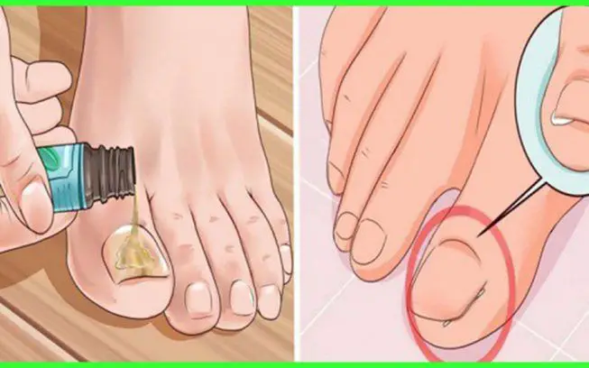 Heals ingrown nails Prepare it in 5 minutes and suffer no more!
