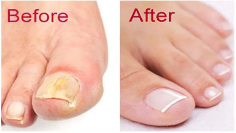 Home remedies to end finger and toenail fungus