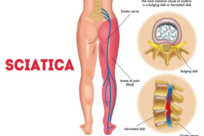 With this remedy you will not feel sciatica or back pain again
