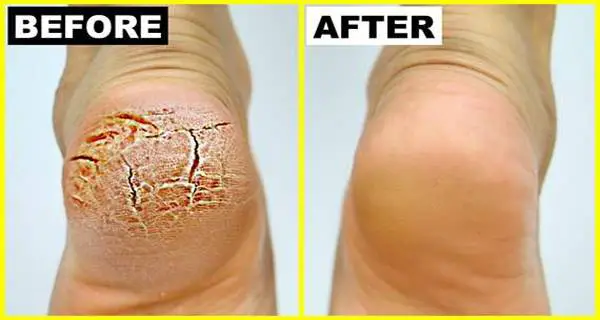 This remedy works wonders! Heals Varicose Veins, Calluses, and Cracked Heels in Just 10 Days!