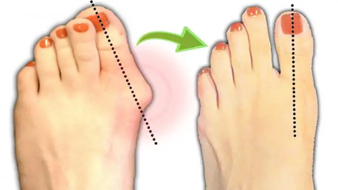 Eliminate bunions naturally with this simple but powerful remedy