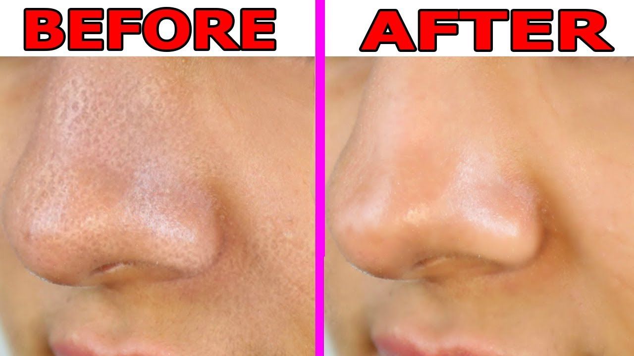 3 Days and All Open Pores Will Disappear from Your Skin Forever!
