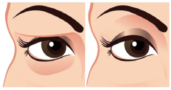 Natural Remedy for Sagging Eyelids – You Will See Results in 2 Minutes!