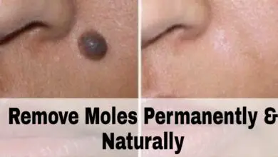 How To Get Rid Of Skin Moles At Home Naturally