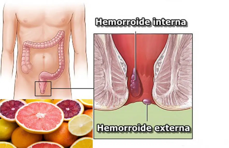 Cure your hemorrhoids in 24 hours with this single kitchen ingredient.